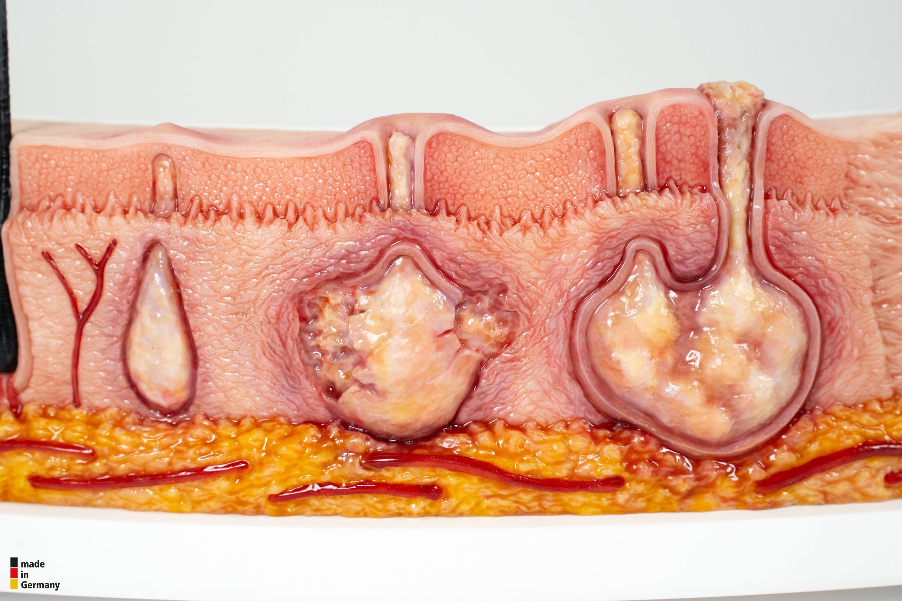 Rahmenmodell Hidradenitis Suppurativa (gebogener Querschnitt) – Bild 3
