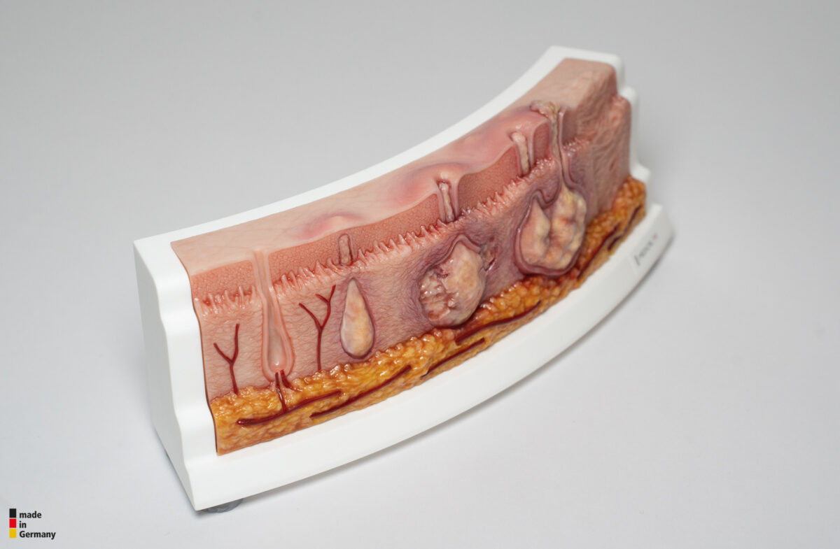 Rahmenmodell Hidradenitis Suppurativa (gebogener Querschnitt)
