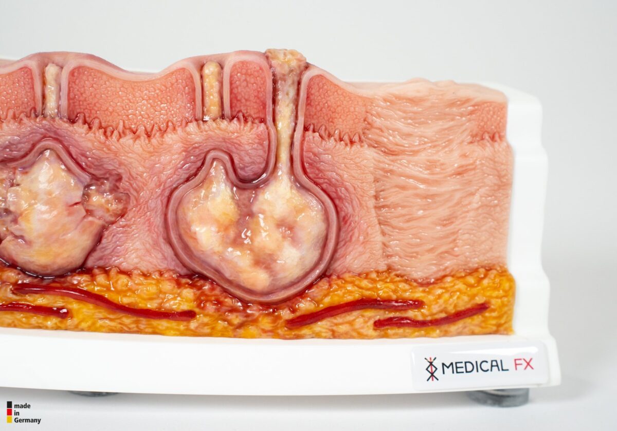 Rahmenmodell Hidradenitis Suppurativa (gebogener Querschnitt)