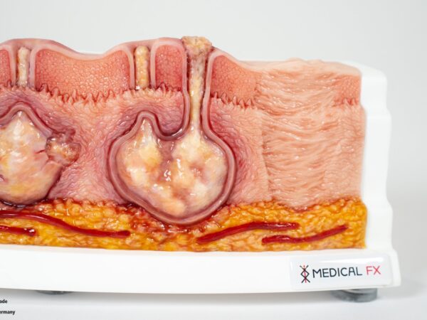 Rahmenmodell Hidradenitis Suppurativa (gebogener Querschnitt) – Bild 4