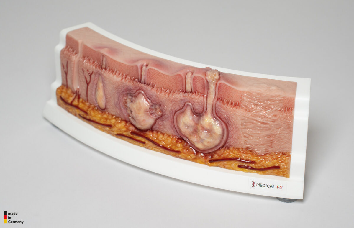 Rahmenmodell Hidradenitis Suppurativa (gebogener Querschnitt)