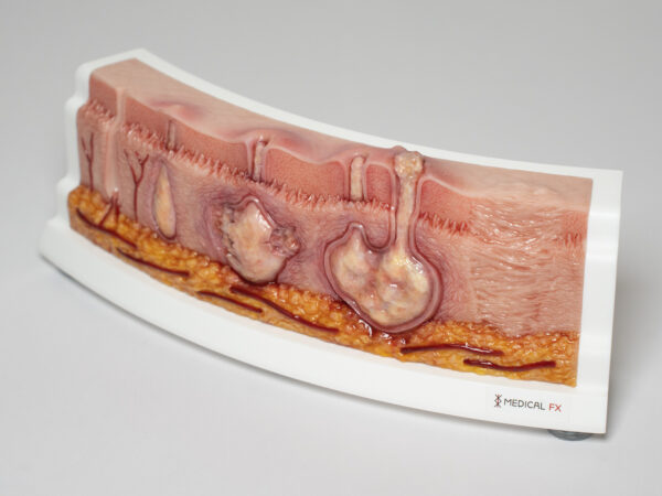 Rahmenmodell Hidradenitis Suppurativa (gebogener Querschnitt) – Bild 5