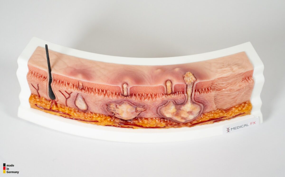 Rahmenmodell Hidradenitis Suppurativa (gebogener Querschnitt)