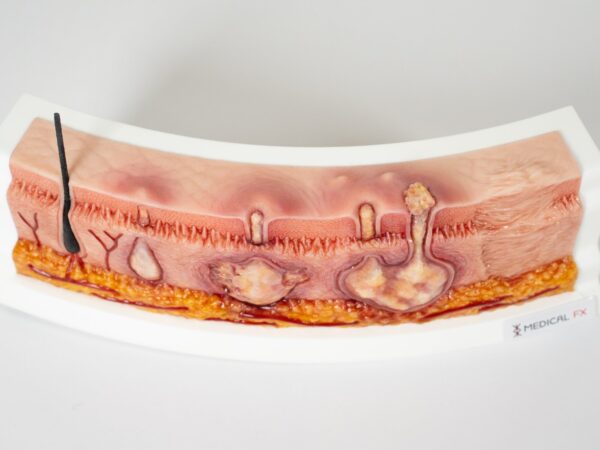 Rahmenmodell Hidradenitis Suppurativa (gebogener Querschnitt) – Bild 13