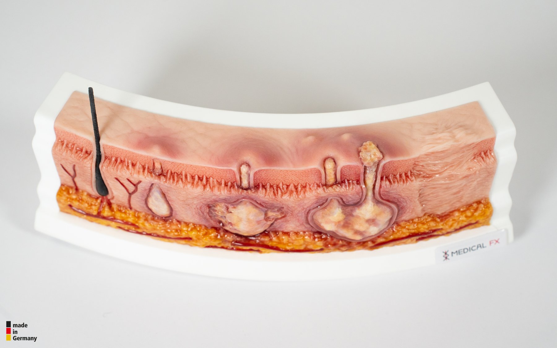 Rahmenmodell Hidradenitis Suppurativa (gebogener Querschnitt) – Bild 13