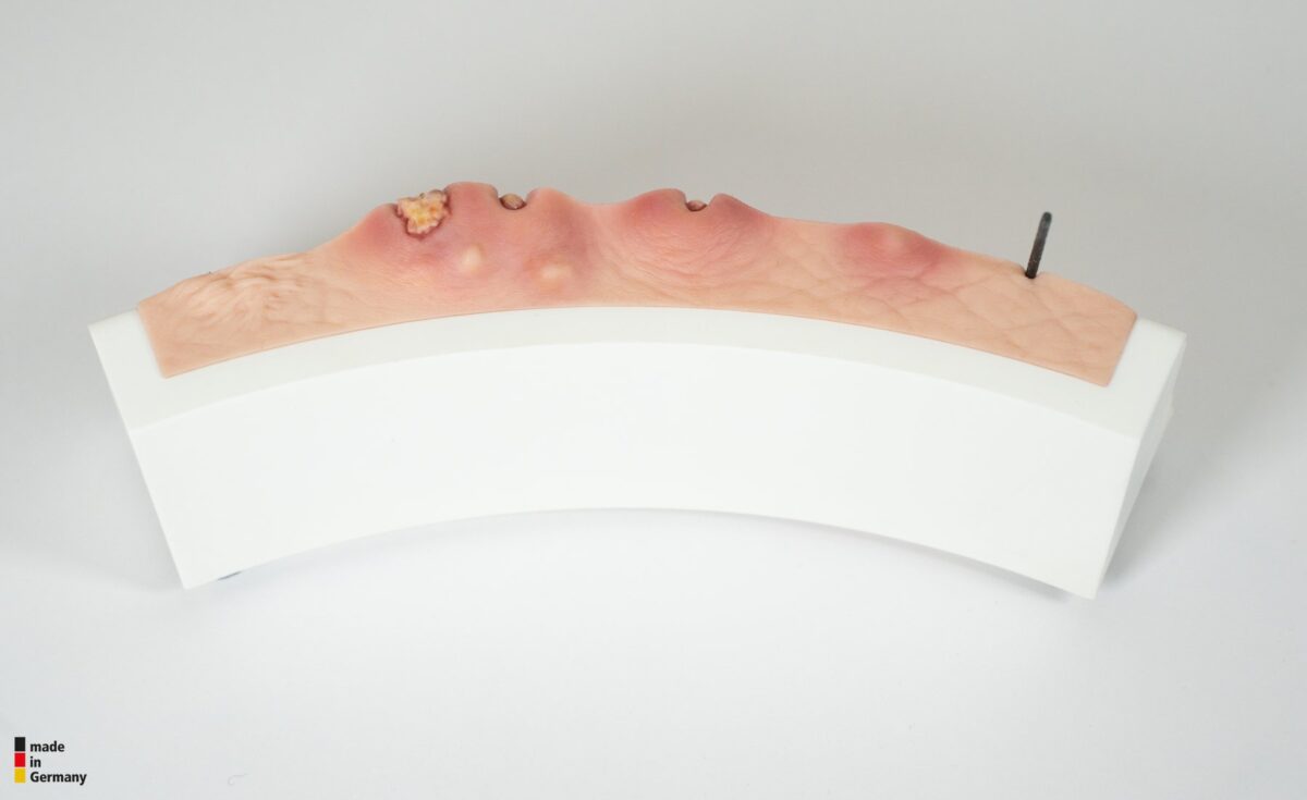 Rahmenmodell Hidradenitis Suppurativa (gebogener Querschnitt)