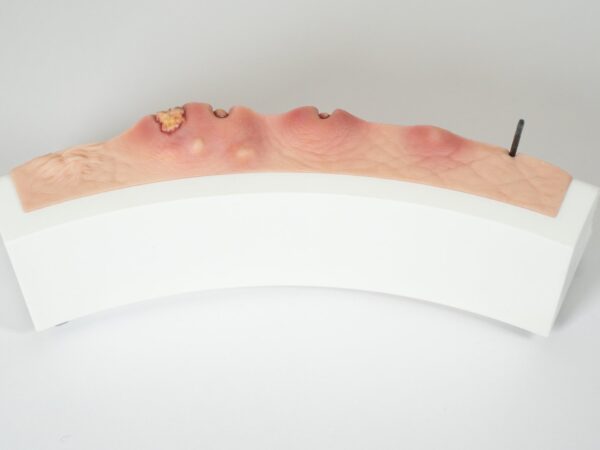 Rahmenmodell Hidradenitis Suppurativa (gebogener Querschnitt) – Bild 14