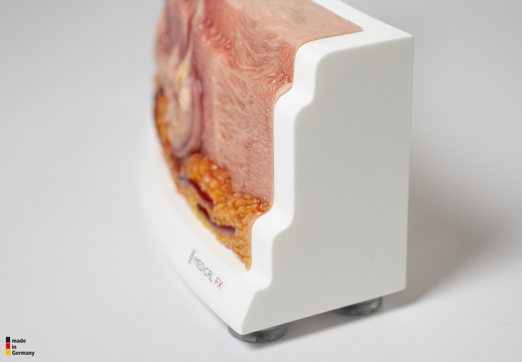 Rahmenmodell Hidradenitis Suppurativa (gebogener Querschnitt) – Bild 6