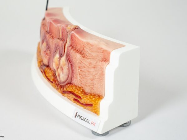 Rahmenmodell Hidradenitis Suppurativa (gebogener Querschnitt) – Bild 15