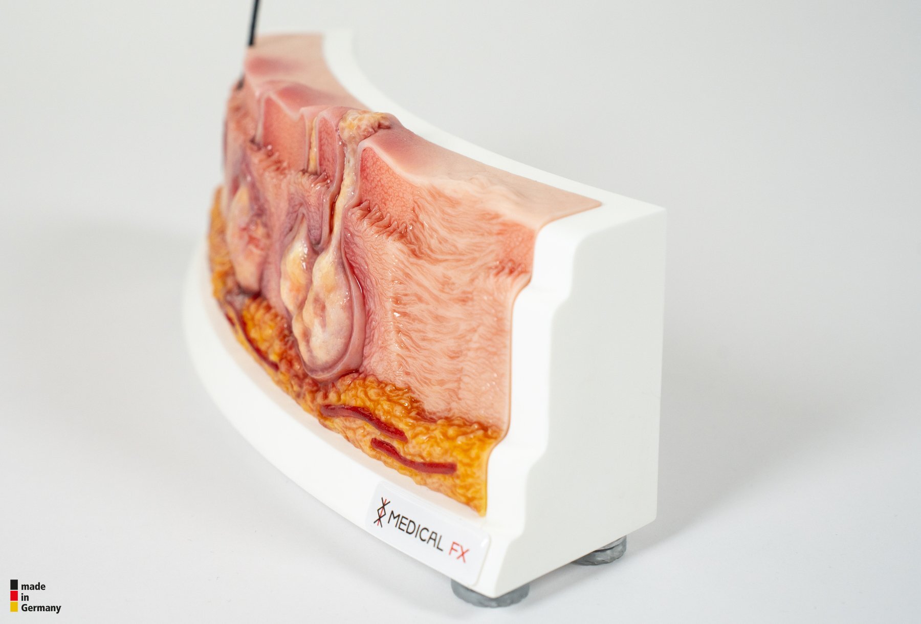 Rahmenmodell Hidradenitis Suppurativa (gebogener Querschnitt) – Bild 15