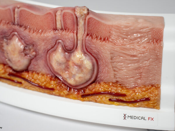 Rahmenmodell Hidradenitis Suppurativa (gebogener Querschnitt) – Bild 7