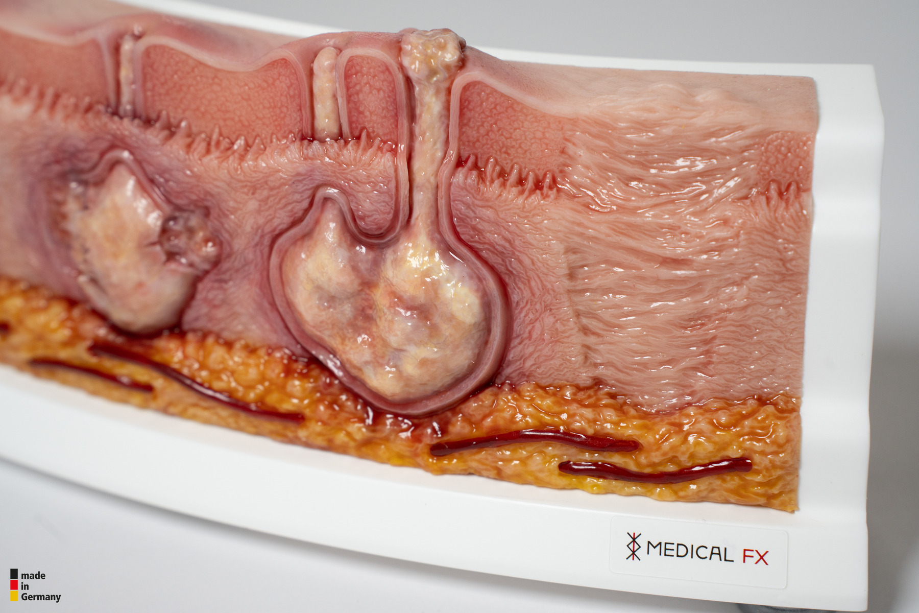 Rahmenmodell Hidradenitis Suppurativa (gebogener Querschnitt) – Bild 7