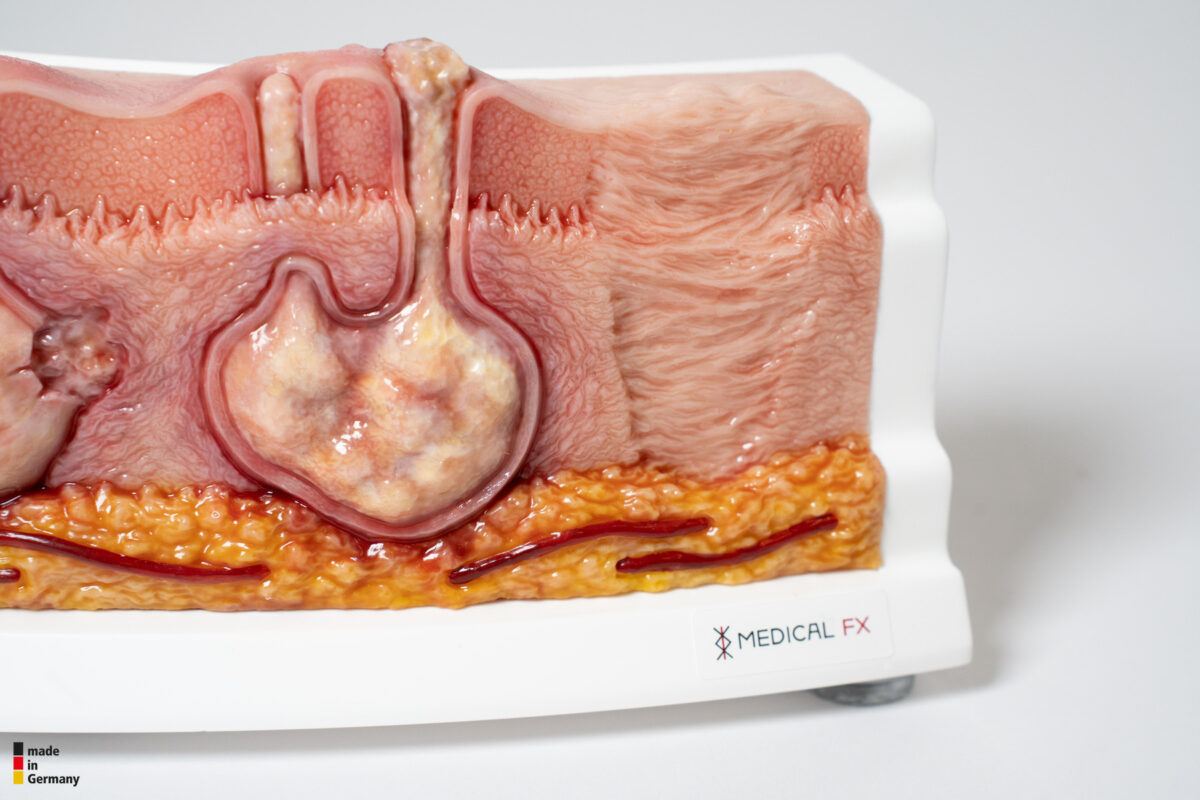 Rahmenmodell Hidradenitis Suppurativa (gebogener Querschnitt)