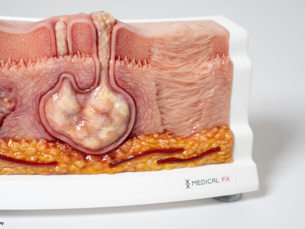 Rahmenmodell Hidradenitis Suppurativa (gebogener Querschnitt) – Bild 8