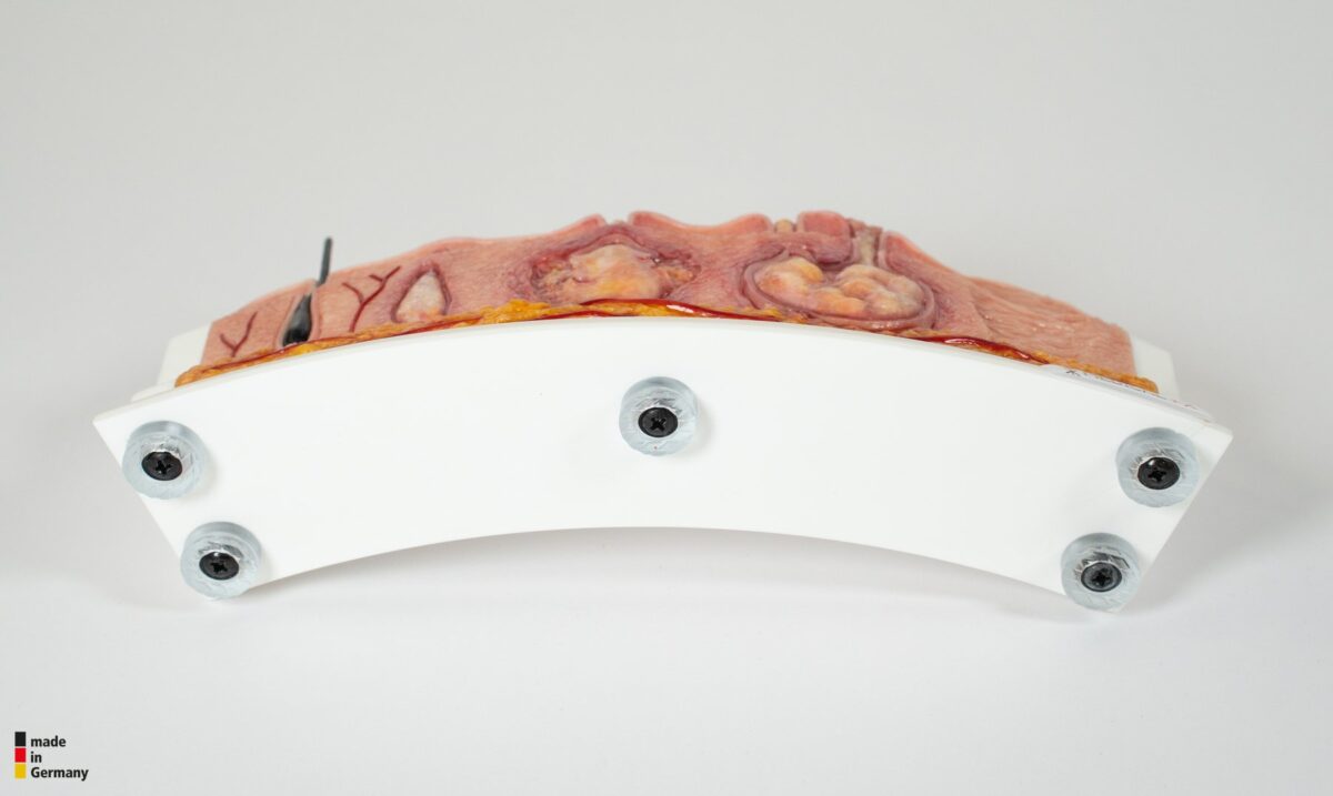Rahmenmodell Hidradenitis Suppurativa (gebogener Querschnitt)