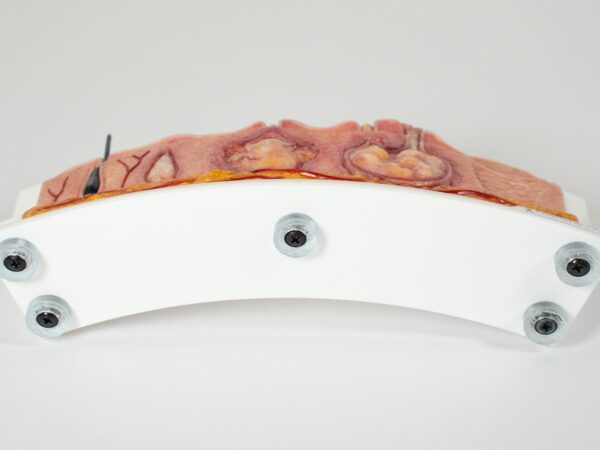 Rahmenmodell Hidradenitis Suppurativa (gebogener Querschnitt) – Bild 17