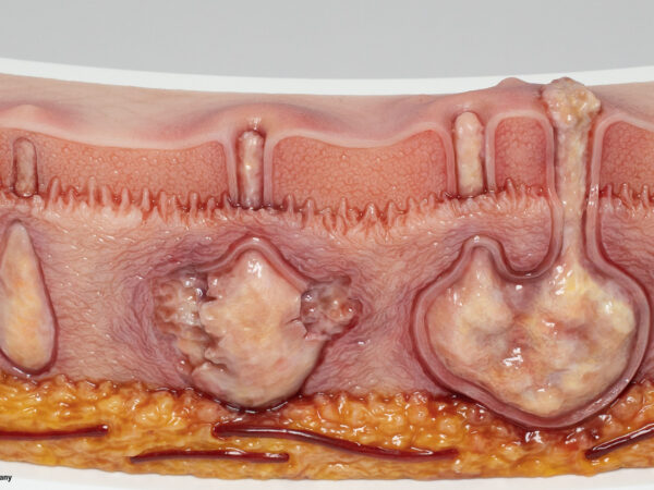 Rahmenmodell Hidradenitis Suppurativa (gebogener Querschnitt) – Bild 9