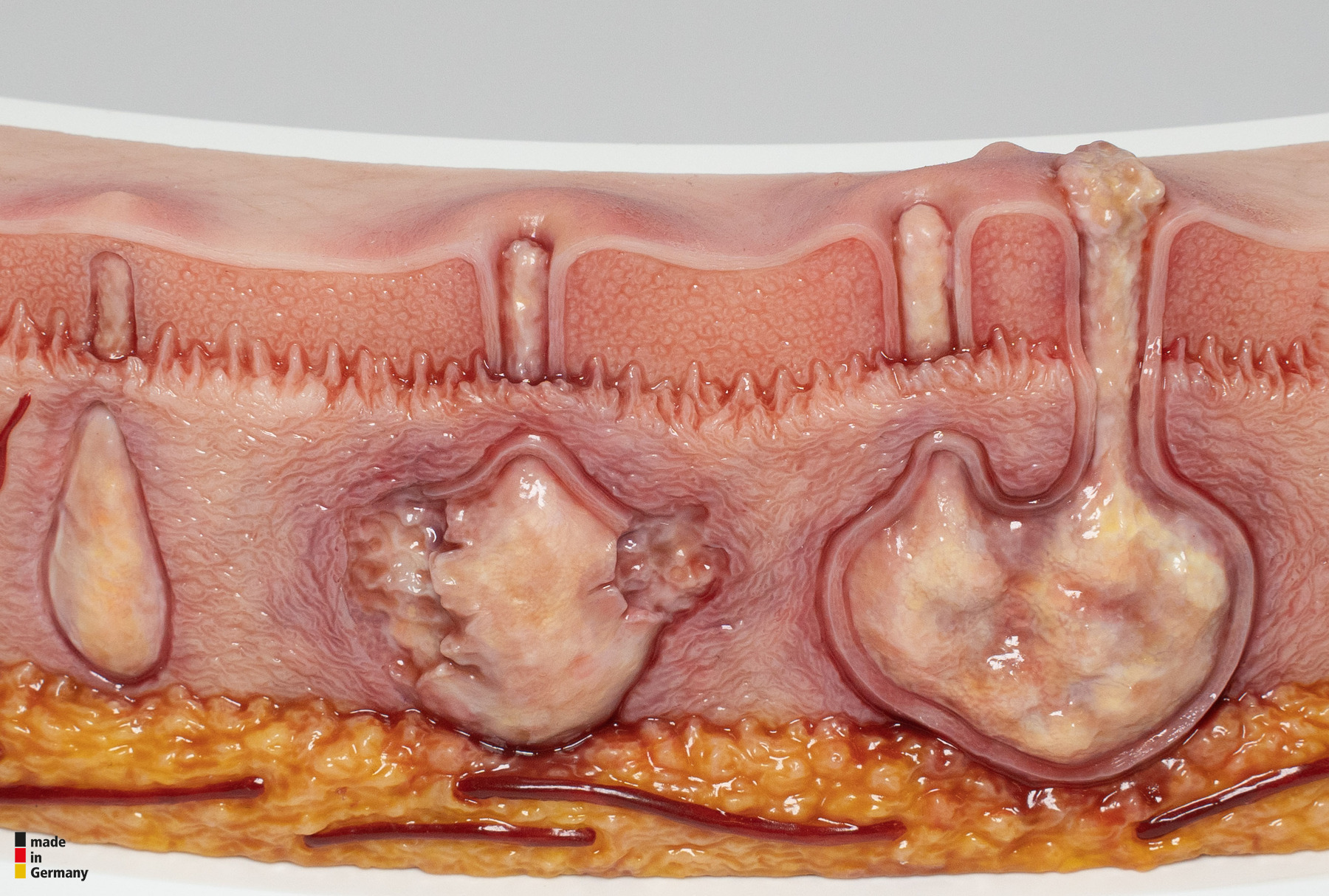 Rahmenmodell Hidradenitis Suppurativa (gebogener Querschnitt) – Bild 9