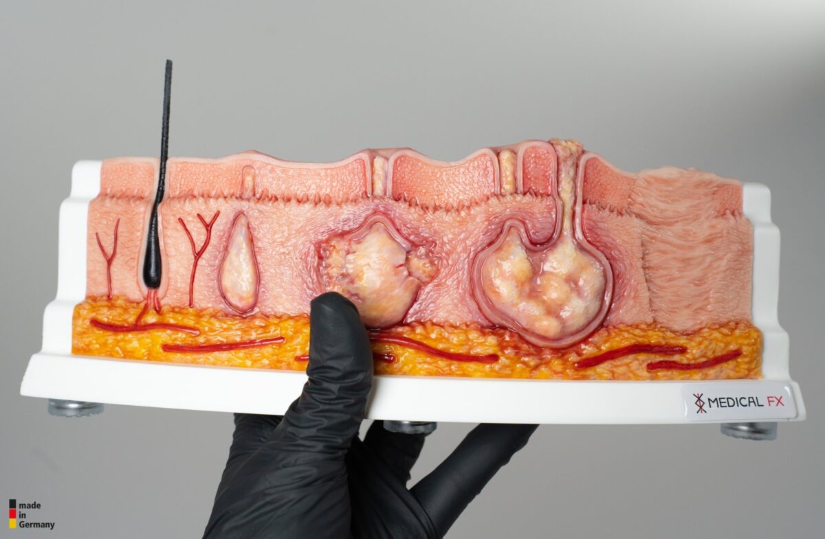 Rahmenmodell Hidradenitis Suppurativa (gebogener Querschnitt)