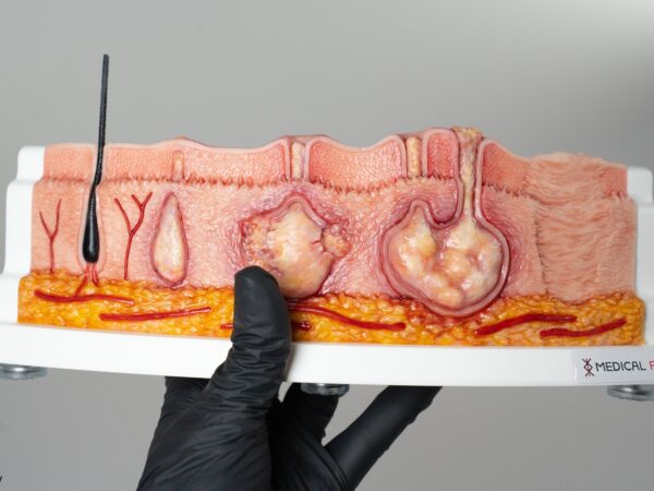 Rahmenmodell Hidradenitis Suppurativa (gebogener Querschnitt) – Bild 5