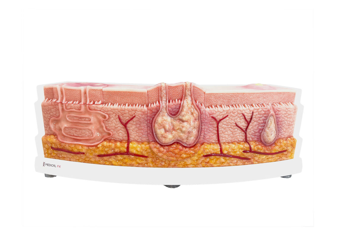 Rahmenmodell Interaktives Modell Hidradenitis Suppurativa