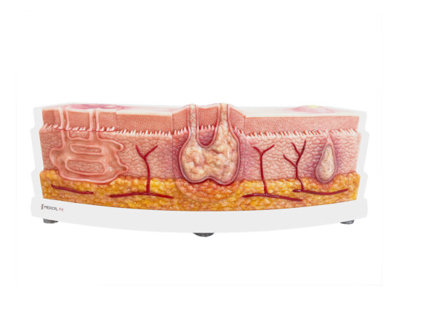 Rahmenmodell Interaktives Modell Hidradenitis Suppurativa