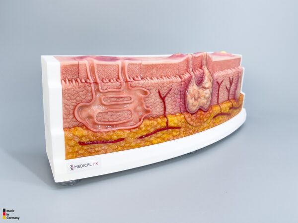 Rahmenmodell Interaktives Modell Hidradenitis Suppurativa – Bild 8
