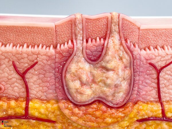 Rahmenmodell Interaktives Modell Hidradenitis Suppurativa – Bild 5