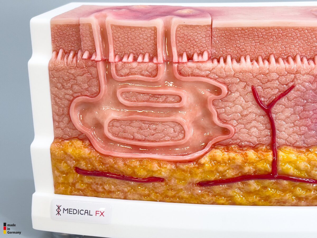 Rahmenmodell Interaktives Modell Hidradenitis Suppurativa