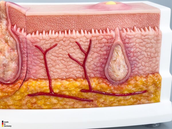 Rahmenmodell Interaktives Modell Hidradenitis Suppurativa – Bild 6