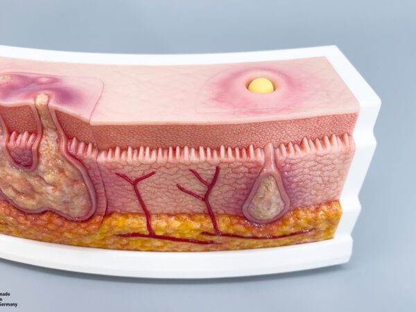 Rahmenmodell Interaktives Modell Hidradenitis Suppurativa – Bild 17