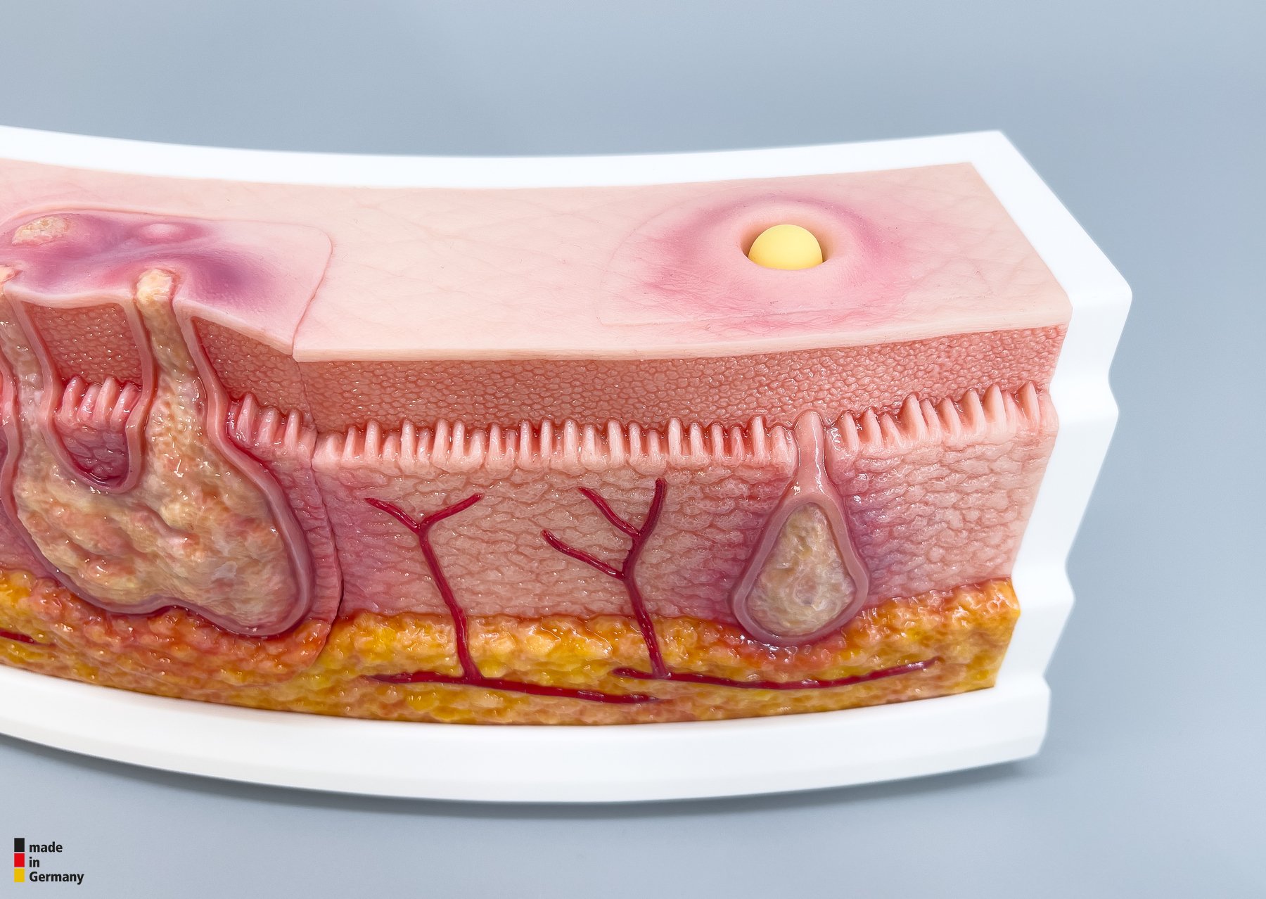 Rahmenmodell Interaktives Modell Hidradenitis Suppurativa – Bild 17