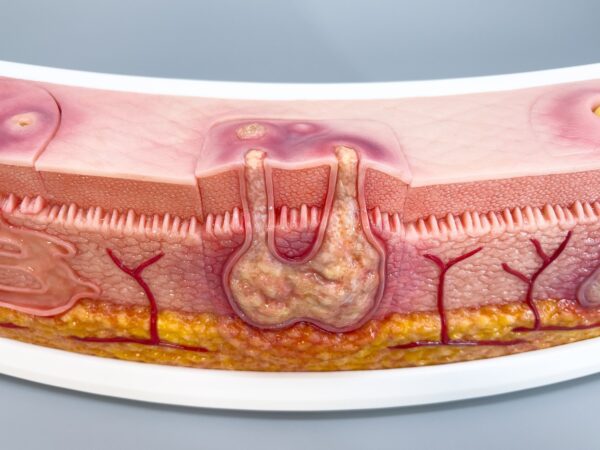 Rahmenmodell Interaktives Modell Hidradenitis Suppurativa – Bild 9