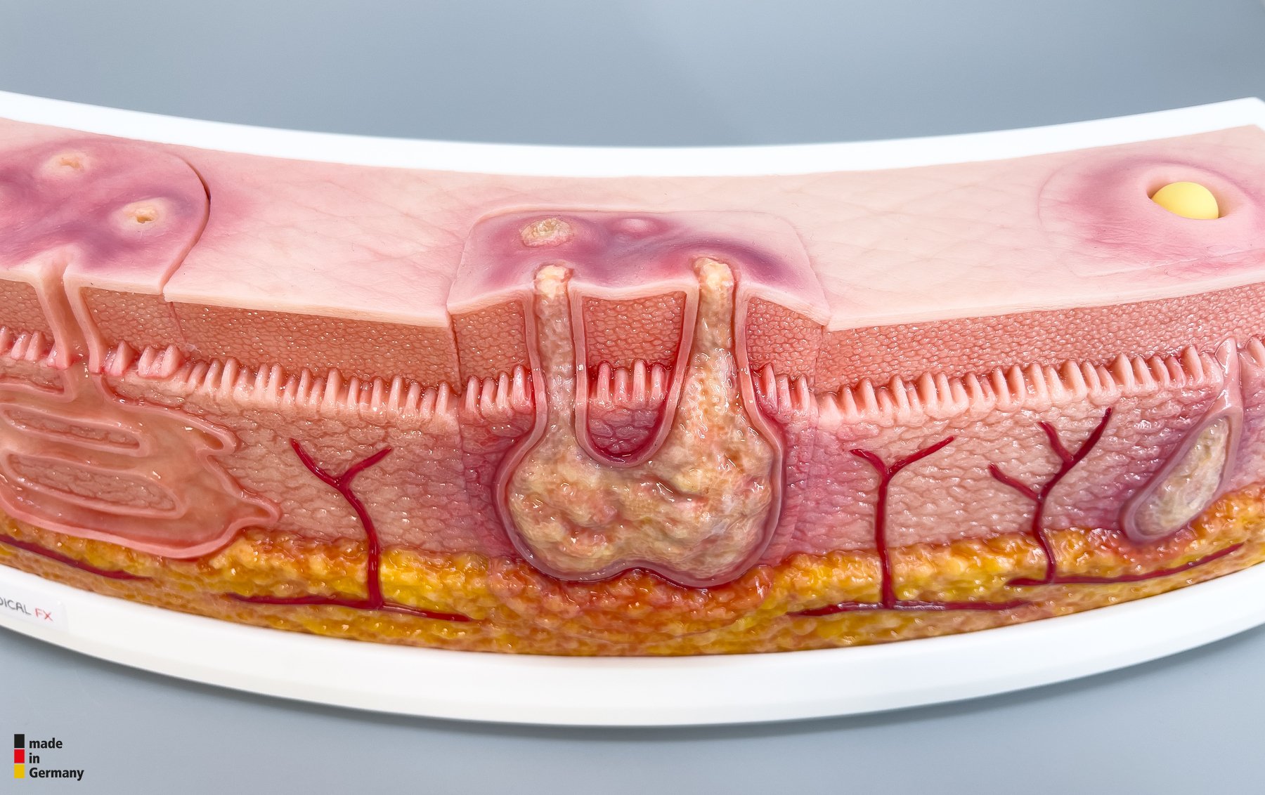 Rahmenmodell Interaktives Modell Hidradenitis Suppurativa – Bild 9