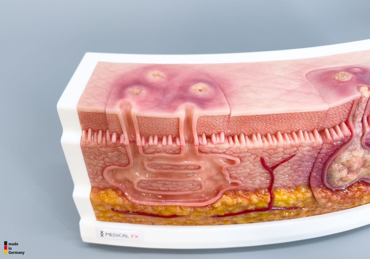 Rahmenmodell Interaktives Modell Hidradenitis Suppurativa