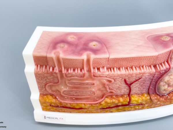 Rahmenmodell Interaktives Modell Hidradenitis Suppurativa – Bild 10