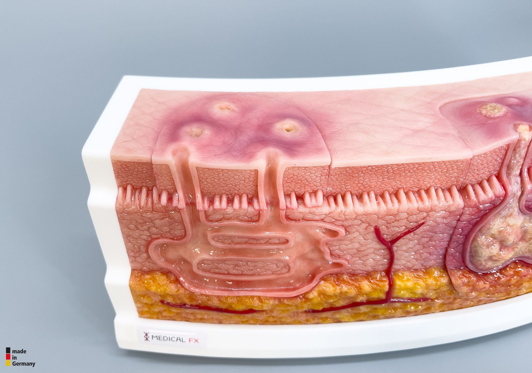 Rahmenmodell Interaktives Modell Hidradenitis Suppurativa – Bild 10