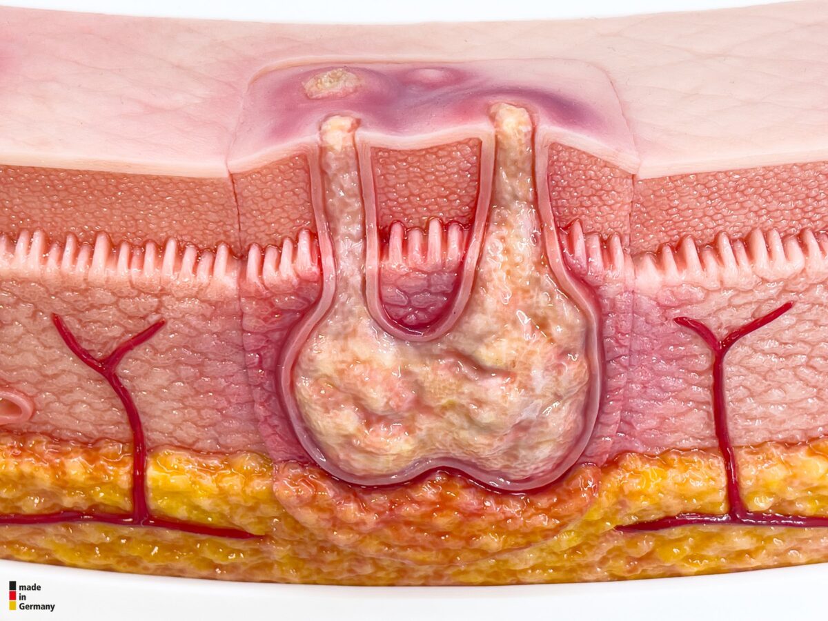 Rahmenmodell Interaktives Modell Hidradenitis Suppurativa