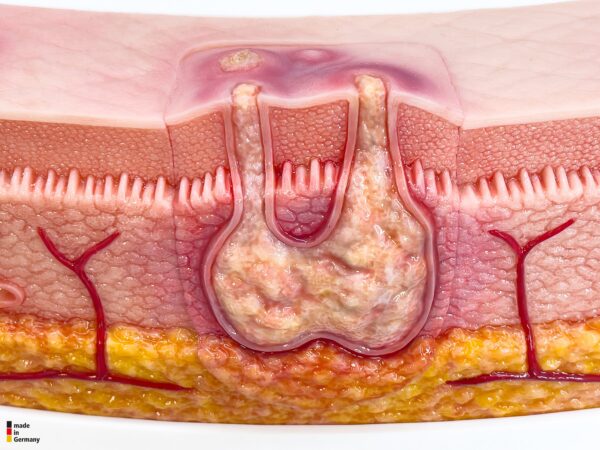 Rahmenmodell Interaktives Modell Hidradenitis Suppurativa – Bild 16