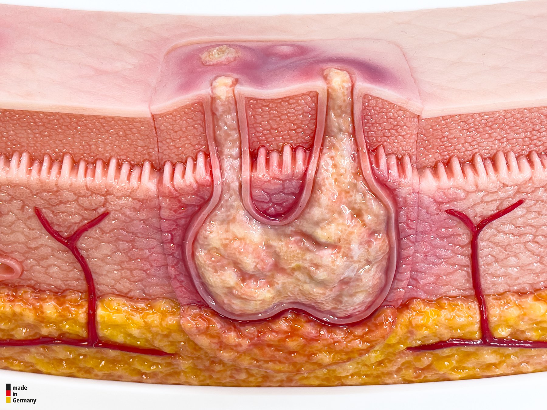 Rahmenmodell Interaktives Modell Hidradenitis Suppurativa – Bild 16