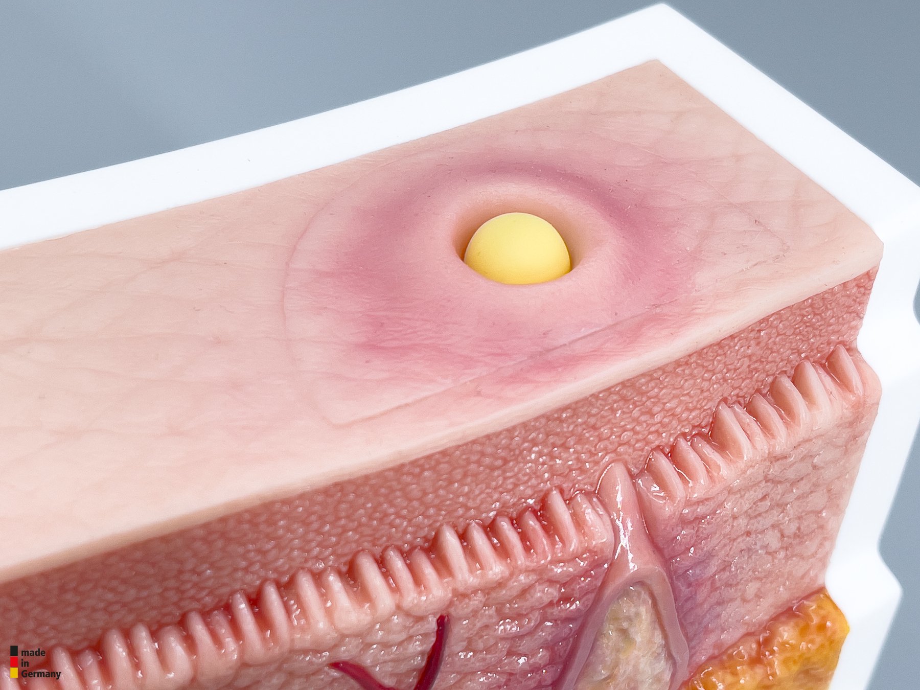 Rahmenmodell Interaktives Modell Hidradenitis Suppurativa – Bild 11