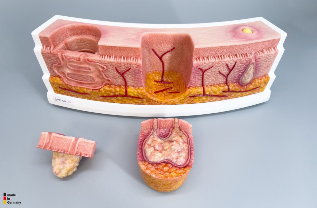 Rahmenmodell Interaktives Modell Hidradenitis Suppurativa