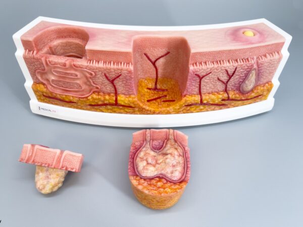 Rahmenmodell Interaktives Modell Hidradenitis Suppurativa – Bild 2