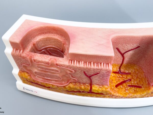 Rahmenmodell Interaktives Modell Hidradenitis Suppurativa – Bild 15