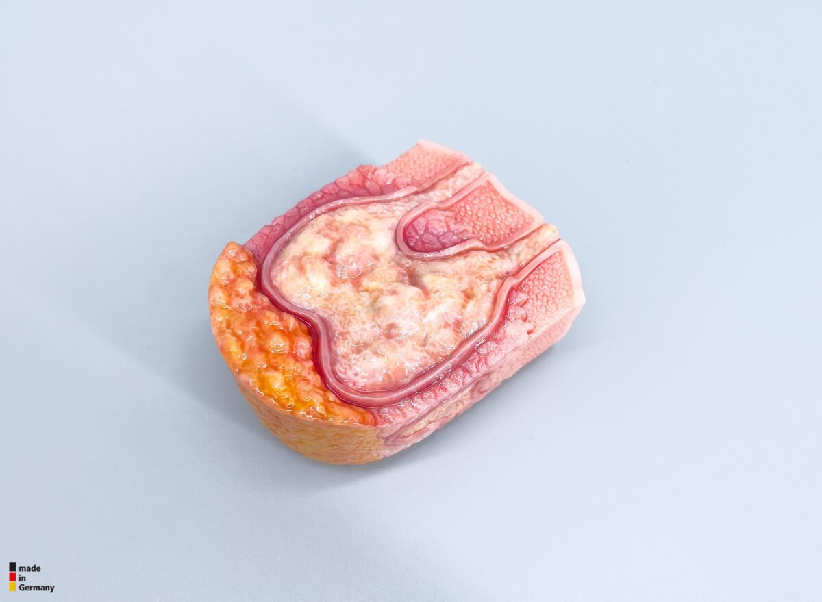 Rahmenmodell Interaktives Modell Hidradenitis Suppurativa