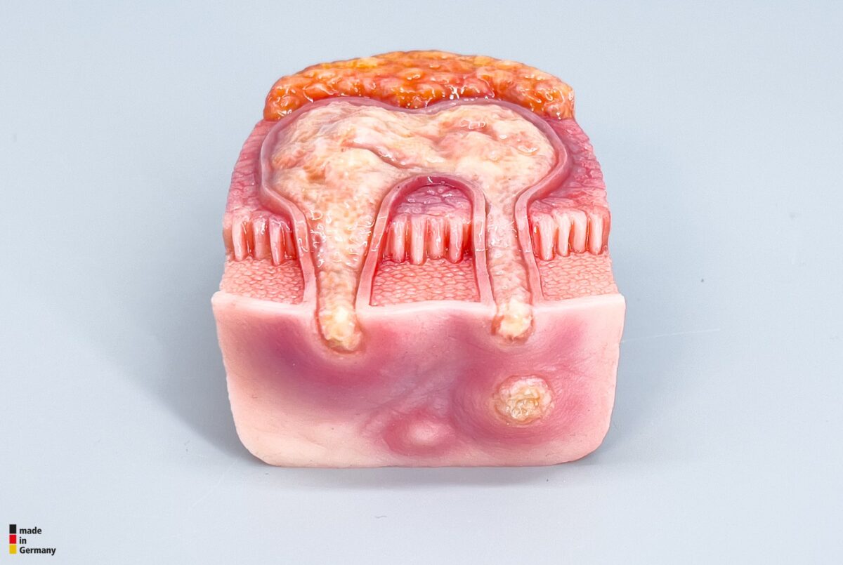 Rahmenmodell Interaktives Modell Hidradenitis Suppurativa