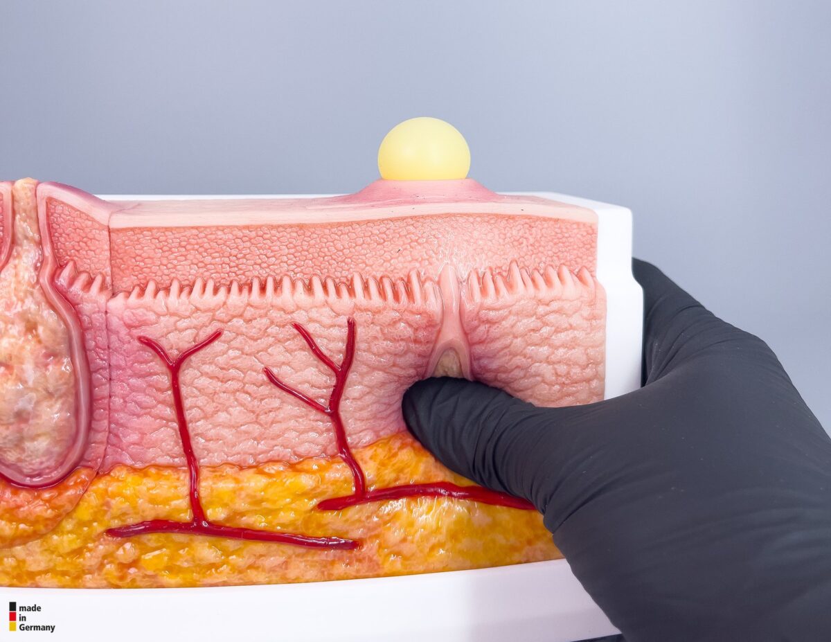 Rahmenmodell Interaktives Modell Hidradenitis Suppurativa