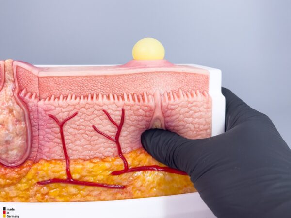 Rahmenmodell Interaktives Modell Hidradenitis Suppurativa – Bild 3