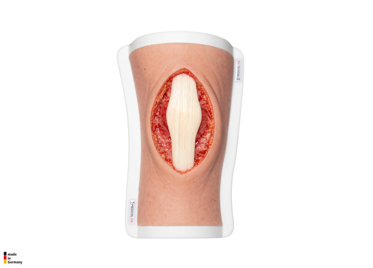 Knie mit 2 freiliegenden Sehnen, Patellasehne, Quadrizepssehne