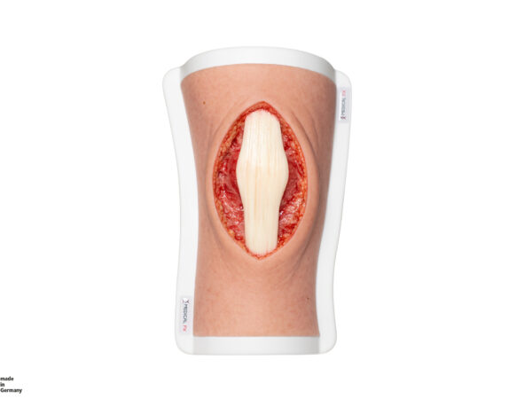 Knie mit 2 freiliegenden Sehnen, Patellasehne, Quadrizepssehne